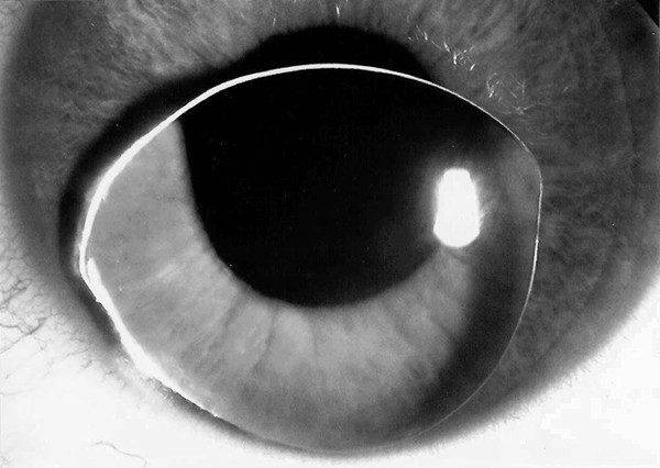 Emergency use of pilocarpine and pupil block glaucoma in ectopia lentis