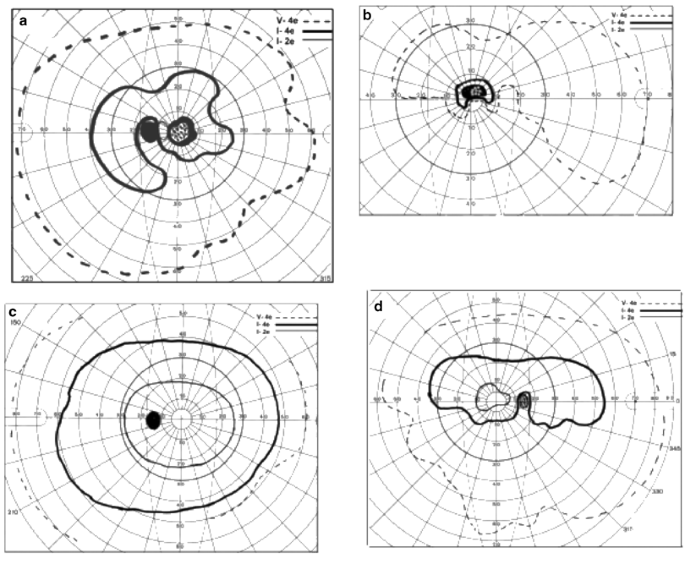 Posterior ischaemic optic neuropathy: clinical features, pathogenesis, and ...