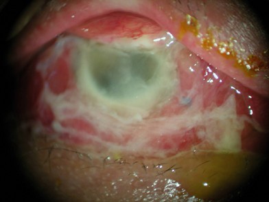Acute postoperative Morganella morganii panophthalmitis