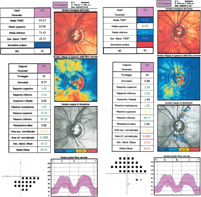 Atypical pattern of retardation on GDx-VCC and its effect on retinal nerve fibre layer evaluation in glaucomatous eyes