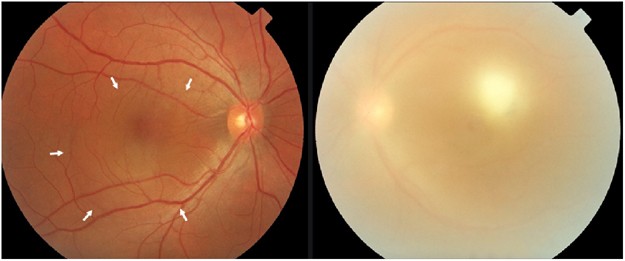 Intravitreal triamcinolone acetonide as an adjunct in the treatment of severe ocular toxoplasmosis