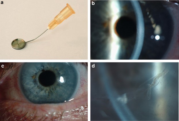 A method for true endothelial cell (tencell) transplantation using a custom-made cannula for the treatment of endothelial cell failure
