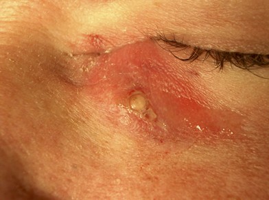 Furuncular Myiasis Of The Face Caused By Larva Of The Tumbu Fly Cordylobia Anthropophaga Eye