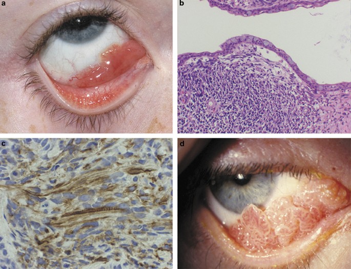 conjunctival mass papilloma