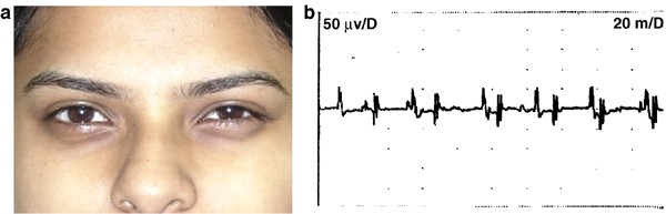 Ptosis caused by orbicularis myokymia and treated with botulinum toxin: a case report | Eye