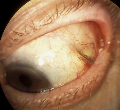 Transmuscular migration of solid silicone band