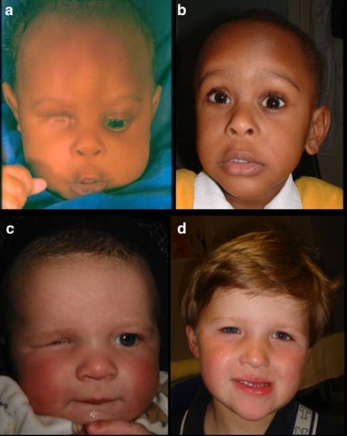 A practical guide to the management of anophthalmia and microphthalmia | Eye