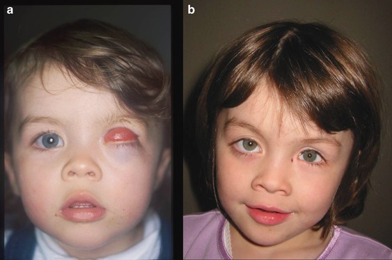 A practical guide to the management of anophthalmia and microphthalmia | Eye