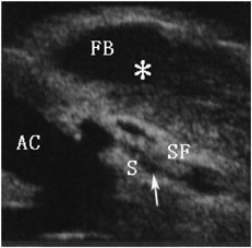 The effects of phacoemulsification on intraocular pressure and ultrasound biomicroscopic image of filtering bleb in eyes with cataract and functioning filtering blebs