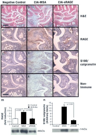 Rage and arthritis: the g82s polymorphism amplifies the inflammatory response