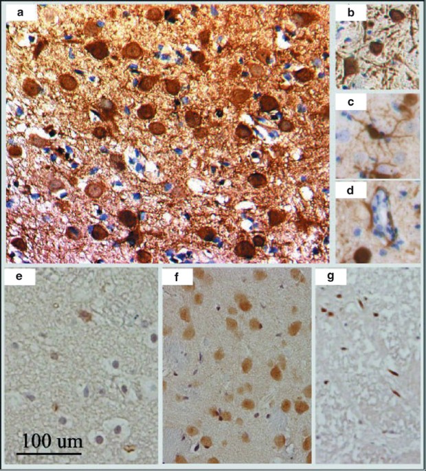 Adeno-associated virus-mediated delivery of bcl-w gene improves outcome after transient focal cerebral ischemia