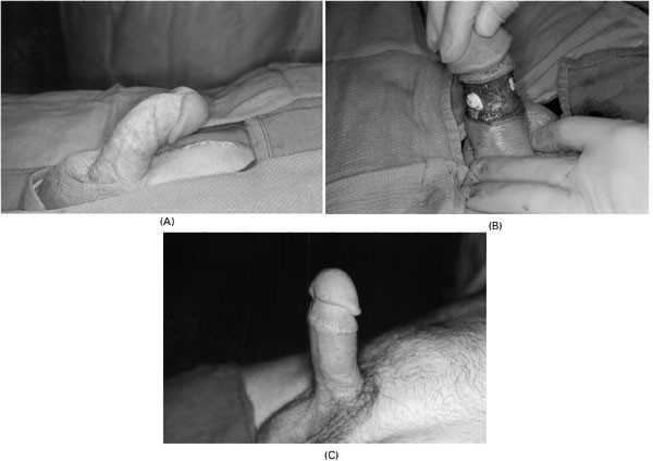 International Journal of Impotence Research - Management of Peyronie...