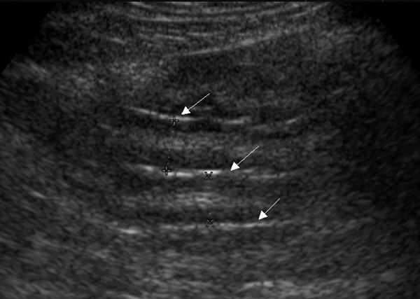 Sonographic measurement of mesenteric fat thickness is a good correlate with cardiovascular risk factors: comparison with subcutaneous and preperitoneal fat thickness, magnetic resonance imaging and anthropometric indexes