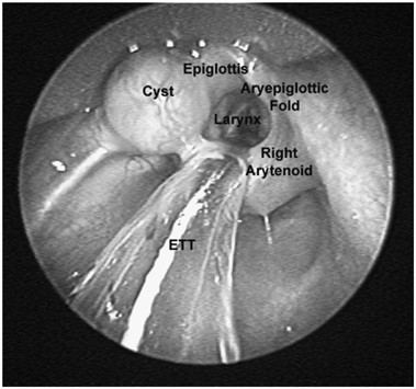 Congenital epiglottic cyst presenting with severe airway obstruction at birth