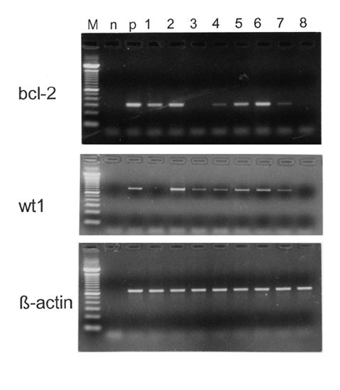 The coexpression of the apoptosis-related genes bcl-2 and wt1 in predicting survival in adult acute myeloid leukemia | Leukemia... 