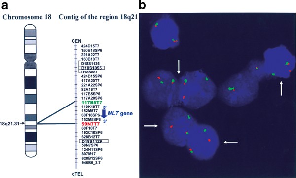 Translocations T 11 18 Q21 Q21 And T 14 18 Q32 Q21 Are The Main Chromosomal Abnormalities Involving Mlt Malt1 In Malt Lymphomas Leukemia
