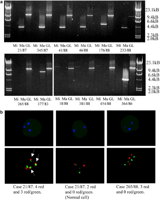 Translocation T 14 18 And Gain Of Chromosome 18 l2 Effects On l2 Expression And Apoptosis In B Cell Non Hodgkin S Lymphomas Leukemia