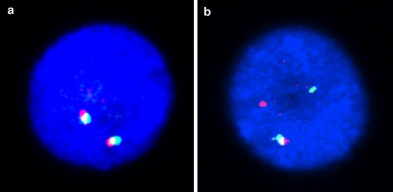 Argbp2, encoding a negative regulator of abl, is fused to mll in a case of infant m5 acute myeloid leukemia involving 4q35 and 11q23