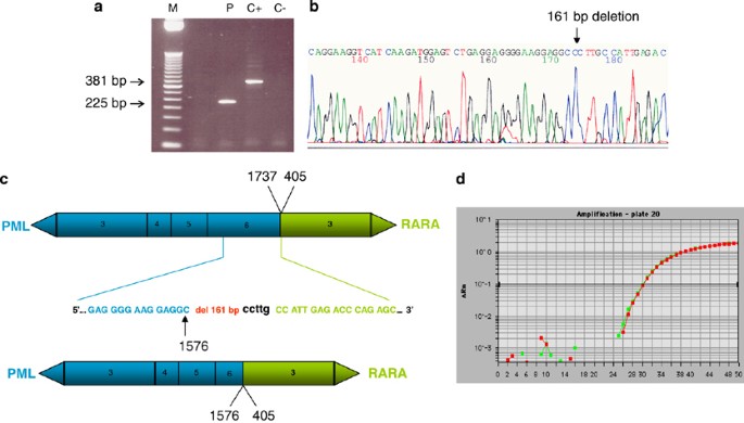 A Large Exon 6 Break In V Form Acute Promyelocytic Leukemia Relevance To Clinical Management Leukemia