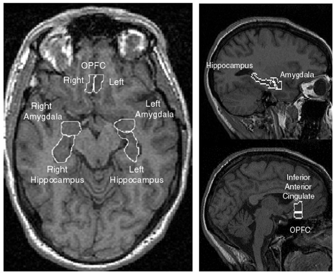 Volumetric Analysis of the Prefrontal Cortex, Amygdala, and Hippocampus in  Major Depression | Neuropsychopharmacology