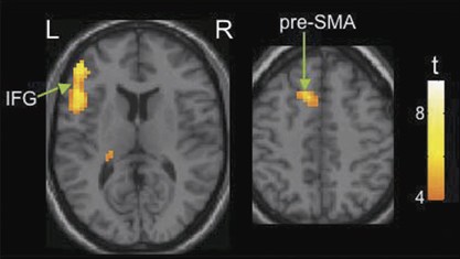 Effect of cigarette smoking on prefrontal cortical function in nondeprived smokers performing the stroop task