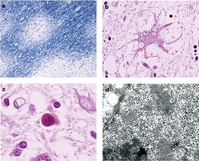 Human neurotropic polyomavirus, jcv, and its role in carcinogenesis