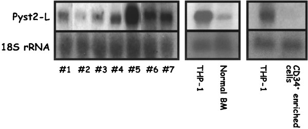 Dual-specificity phosphatase pyst2-l is constitutively highly expressed in myeloid leukemia and other malignant cells