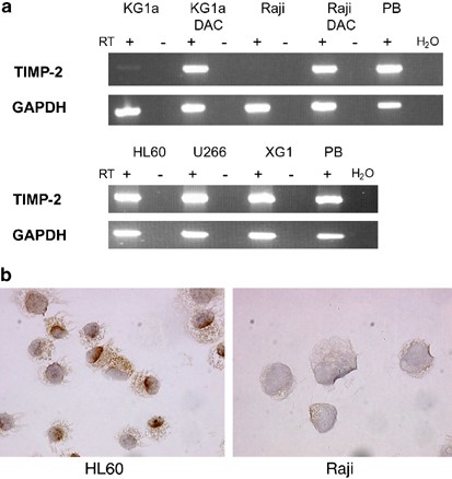 Inactivation of the tissue inhibitor of metalloproteinases-2 gene by promoter hypermethylation in lymphoid malignancies