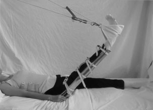 Muscle stretching for treatment and prevention of contracture in people with spinal cord injury | Spinal Cord