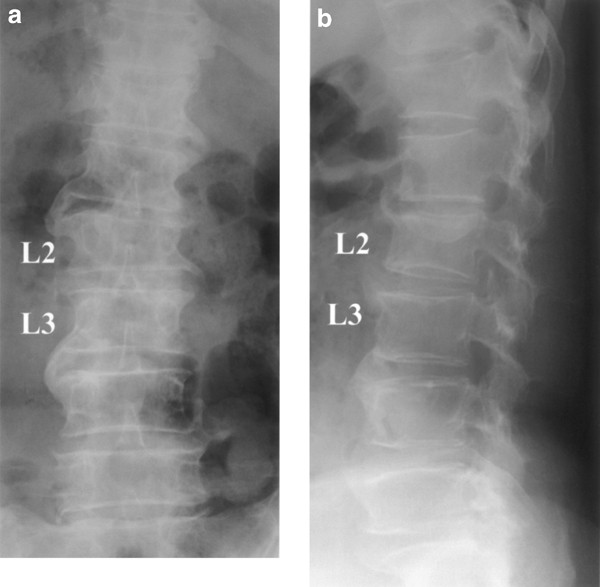 Painful Schmorl's node treated by lumbar interbody fusion | Spinal Cord
