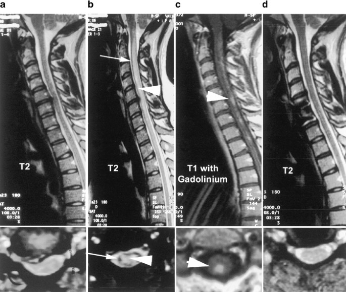 Venous hypertensive myelopathy as a potential mimic of transverse myelitis  | Spinal Cord
