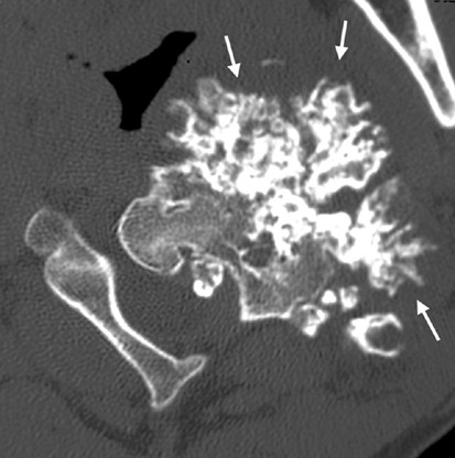 Hereditary multiple exostoses with spinal cord compression.