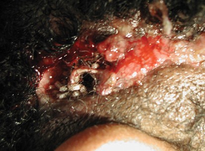 Pin-site myiasis: a rare complication of halo orthosis