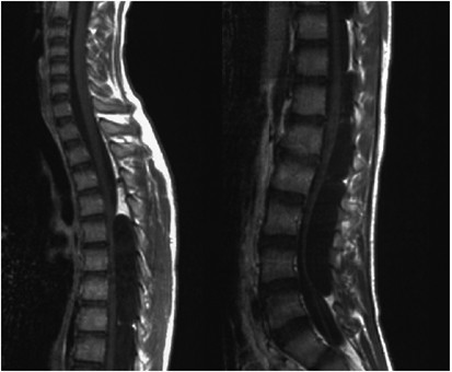 Multiple extradural arachnoid cysts at the spinal cord and cauda equina levels in the young