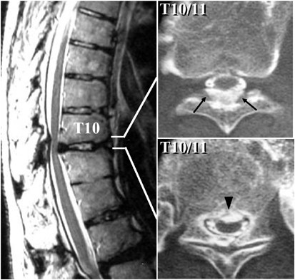 Transient paraparesis after laminectomy for thoracic ossification of the posterior longitudinal ligament and ossification of the ligamentum flavum