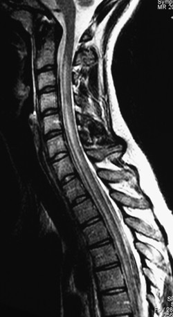 Campylobacter Jejuni Induced Acute Transverse Myelitis Spinal Cord