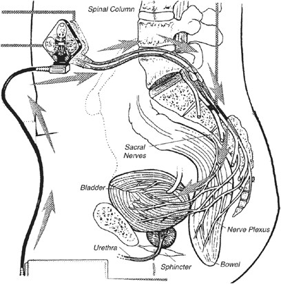 Functional electrical stimulation in neurorehabilitation (Chapter 12) -  Textbook of Neural Repair and Rehabilitation