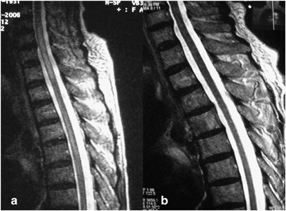 Spinal cord infarction following endoscopic variceal ligation