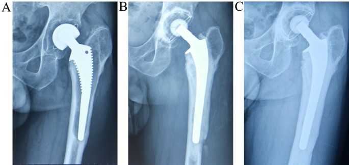 Medium-term Outcomes of Cemented Prostheses and Cementless Modular  Prostheses in Revision Total Hip Arthroplasty | Scientific Reports