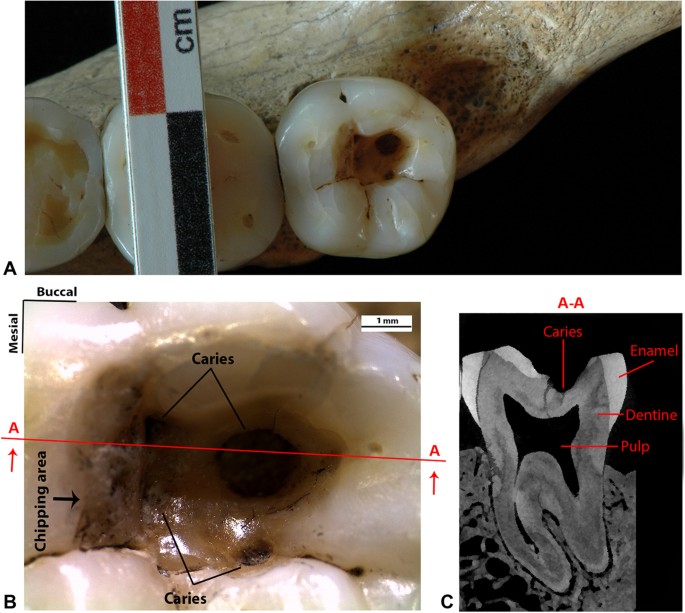Earliest evidence of dental caries manipulation in the Late Upper ... - Nature.com