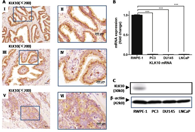 NES1/KLK10 gene represses proliferation, enhances apoptosis and