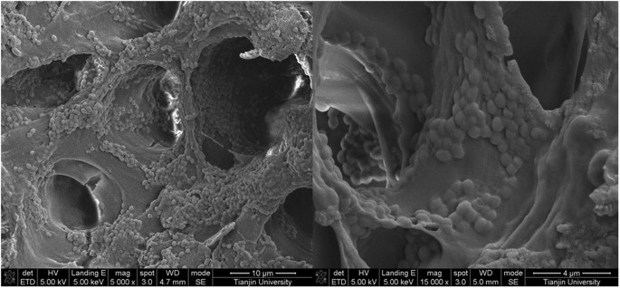 Root Canal Disinfection Using Highly Effective Aggregation-Induced