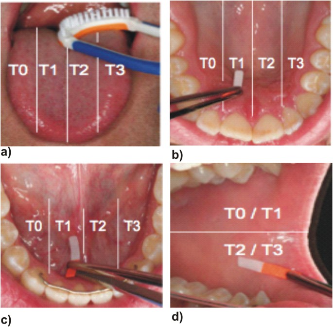 Dynamics of Fluoride Bioavailability in the Biofilms of Different Oral  Surfaces after Amine Fluoride and Sodium Fluoride Application | Scientific  Reports