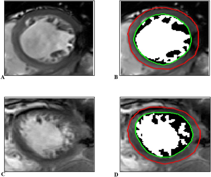 Endocardial Remodeling in Heart Failure Patients with Impaired and Preserved Left Ventricular ...