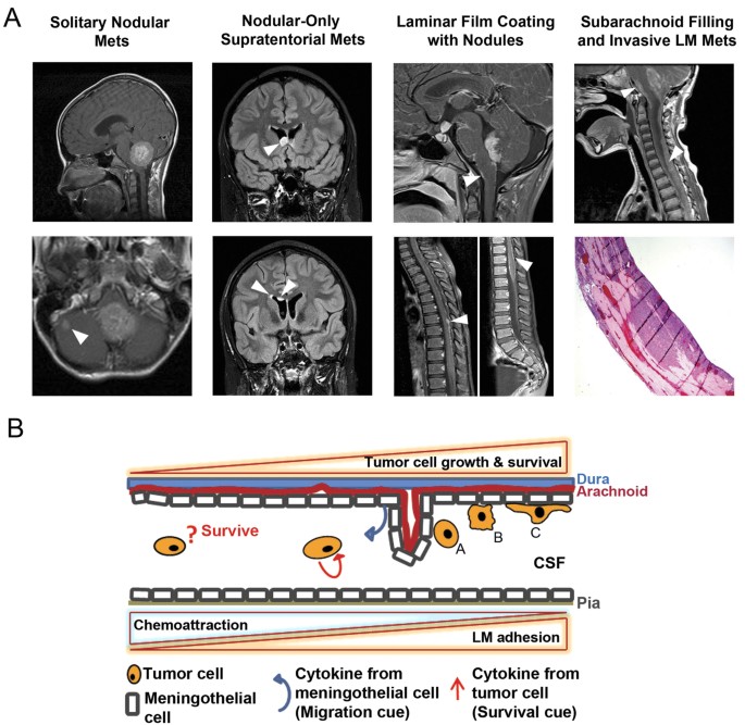 Igf1r As A Key Target In High Risk Metastatic Medulloblastoma Scientific Reports