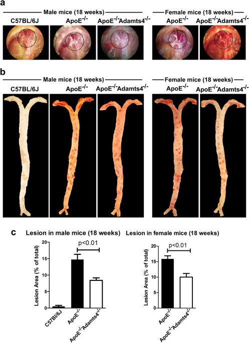 Increased Collagen Turnover Is a Feature of Fibromuscular