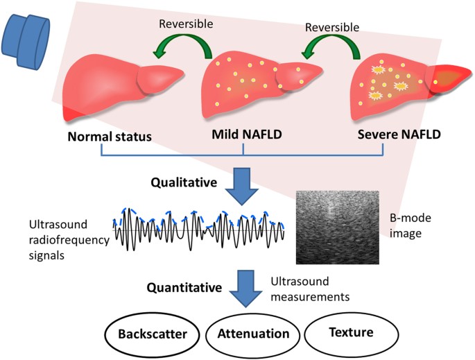 fatty liver disease