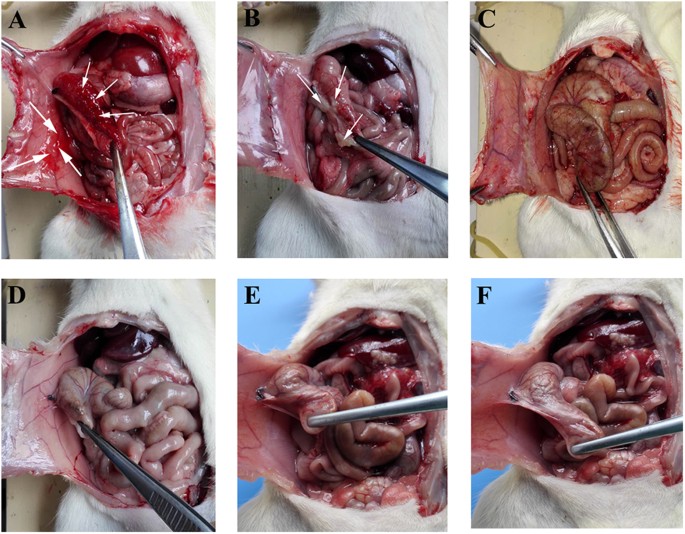 Laparoscopic pictures of the fibrinous adhesion, dark brownish ascetic