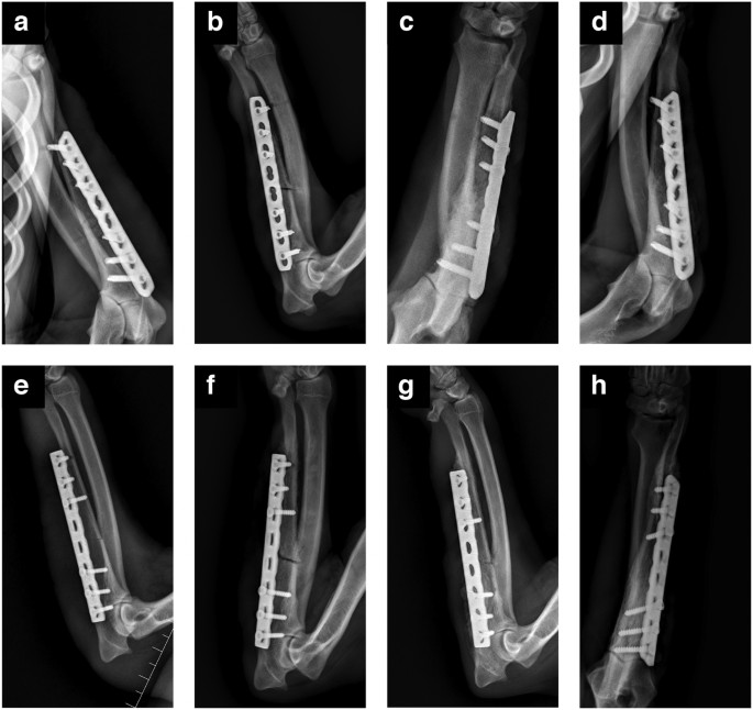 Comparison of the effect on bone healing process of different implants used  in minimally invasive plate osteosynthesis: limited contact dynamic  compression plate versus locking compression plate | Scientific Reports