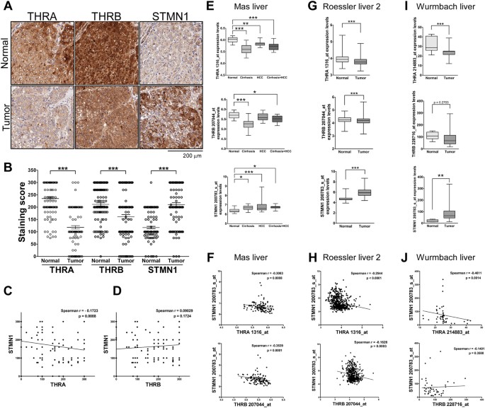 Thyroid hormone suppresses expression of stathmin and associated tumor growth in hepatocellular carcinoma